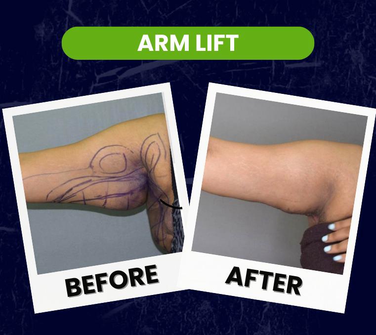arm-lift