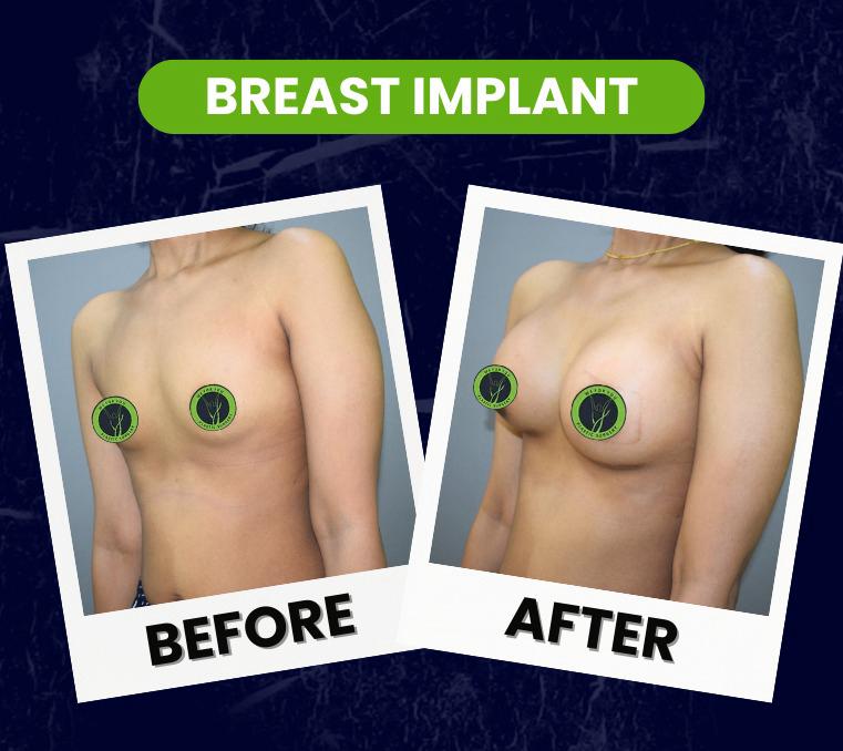 breast implant