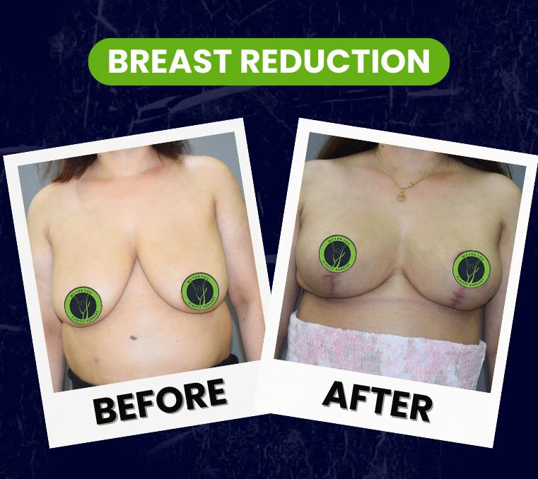 breast reduction
