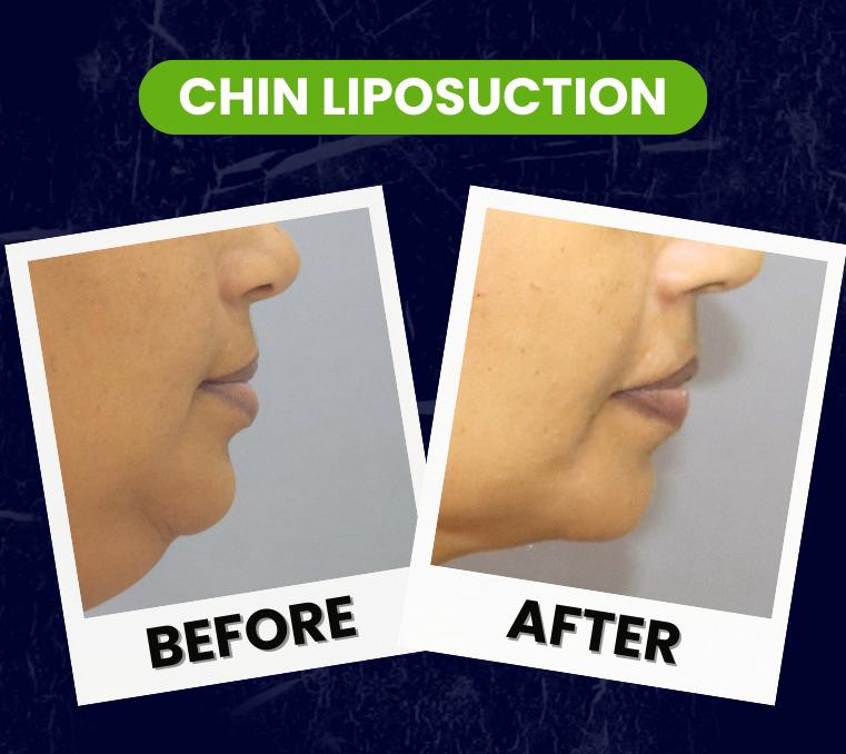 chin liposuction