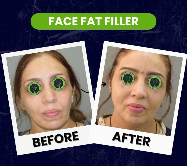face fat filler (1)