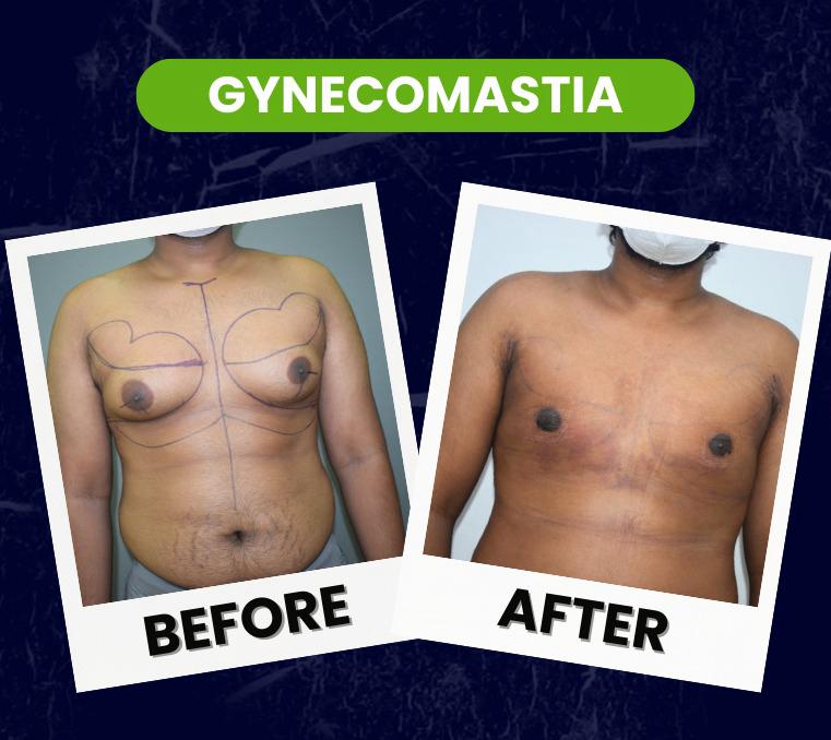 gynicomastia